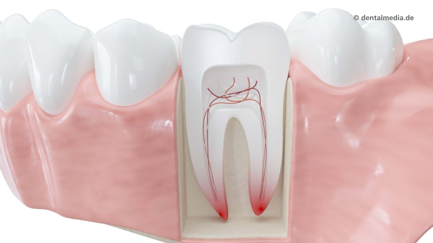 Endodontie : Entzündung des Zahnmarks Entzündung des Zahnmarks